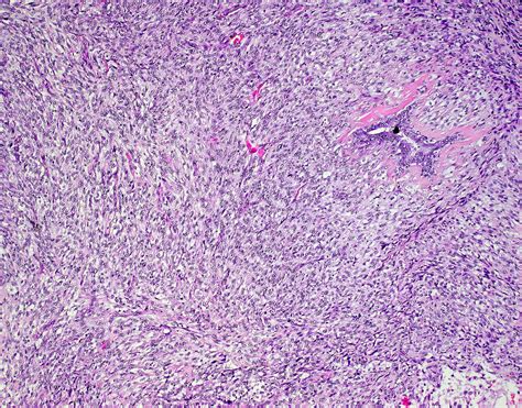 Spindle cell metaplastic carcinoma (breast) – BosnianPathology
