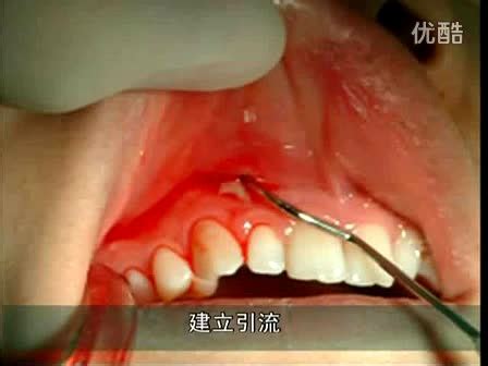 牙槽脓肿切开引流术