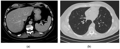 Type I Diabetes—A Rare Adverse Event Described in Patients Receiving ...