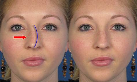 Crooked Nose Before And After Rhinoplasty Nose Surgery Photos | 2018 Plastic Surgery before and ...