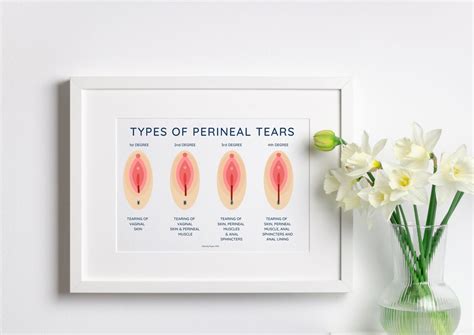 Birth Education Poster Perineal Tears Midwife Education Poster Pelvic ...