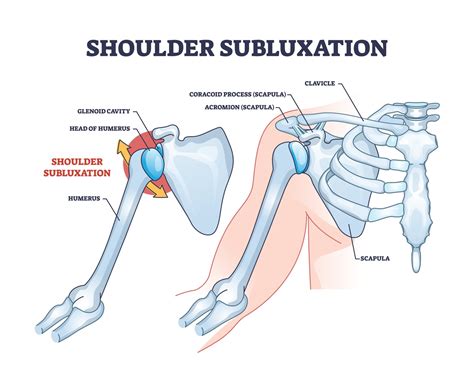 Inferior Shoulder Subluxation X Ray at Ashley Cooper blog