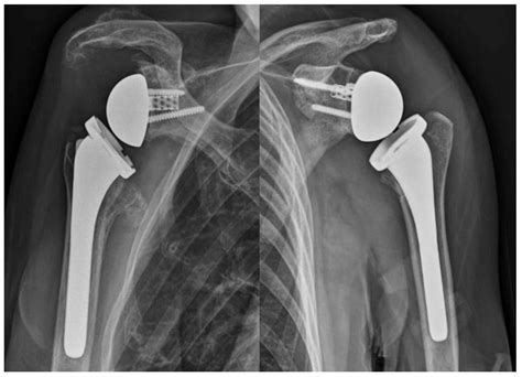 Computer-Assisted Navigation in Reverse Shoulder Arthroplasty: Surgical ...