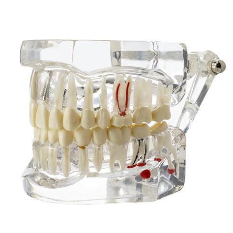 Dental Implant Teeth Model Bridge Restoration | Ubuy India