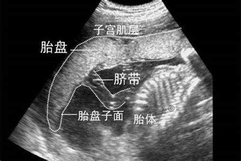 怀孕第几个月胎盘固定？不是3个月，也不是5个月_子宫_胎儿_位置