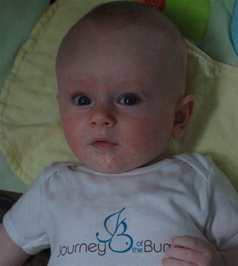 natural remedies diaper rash