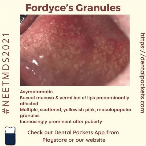 What Are Fordyce Spots - Grain De Fordyce Lèvre - IJUJ