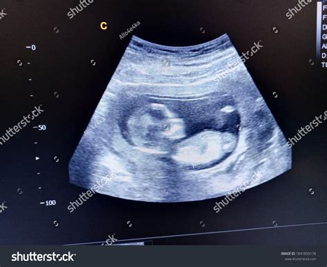 Fetus 15 Weeks By Ultrasound Scan Stock Photo 1841850178 | Shutterstock