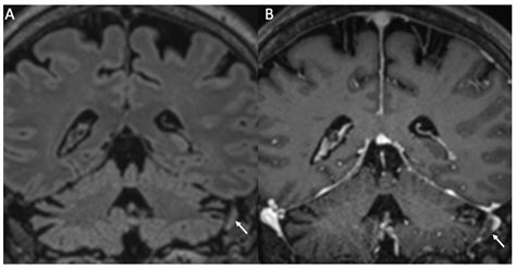 Neuroimaging of the Most Common Meningitis and Encephalitis of Adults ...