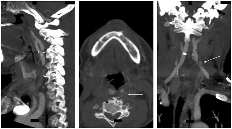 Retropharyngeal carotid artery stenosis; potential for minimizing operative complications ...
