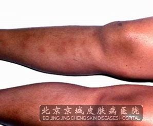 结节性红斑的预防复发方法_结节性红斑_北京京城皮肤医院(北京医保定点机构)