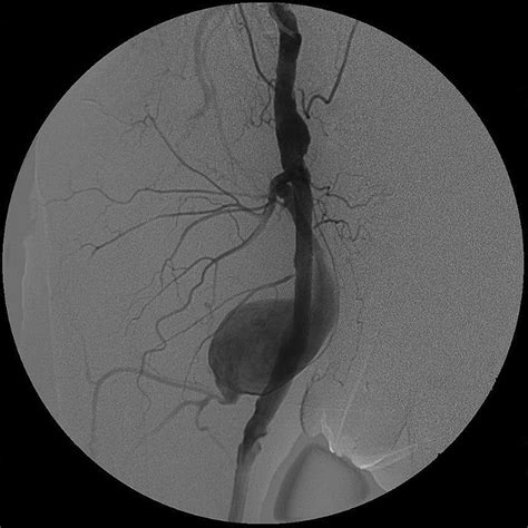 Radiological findings and endovascular treatment in giant deep femoral artery aneurysms | BMJ ...