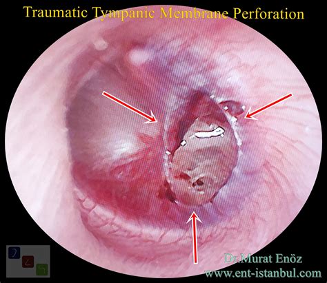 Ruptured Eardrum Pictures