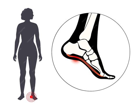 Premium Vector | Pain of the heel anatomical poster ankle and foot diseases calcaneal spur ...