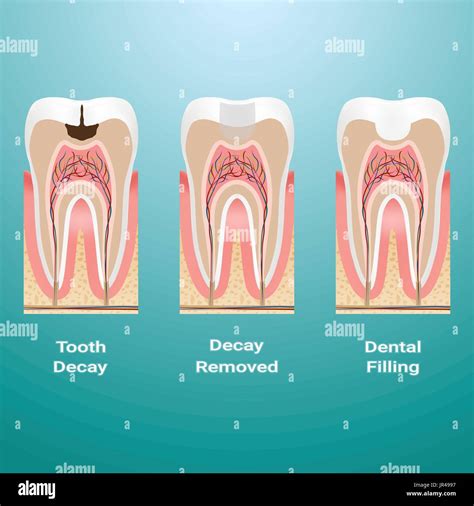 Treatment For Dental Caries