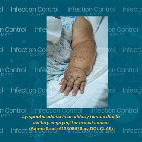 Comprehensive Guide to Lymphedema: Causes, Prevention, and Management Strategies