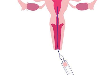 Intra-Uterine Insemination (IUI) : The Steps | WiStim Fertility Application