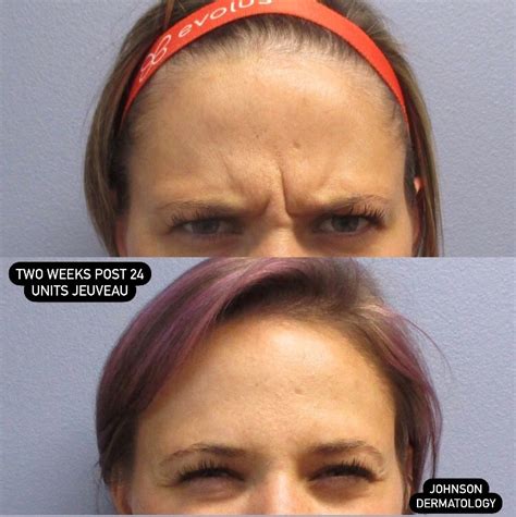 What Botox Looks Like After Years of Use, According to Derms