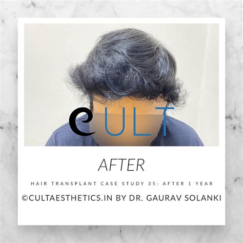Hair Transplant Case Study 35 | Cult Aesthetics