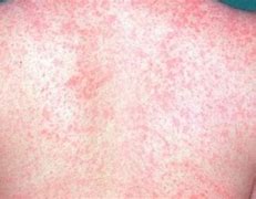 measles 的图像结果