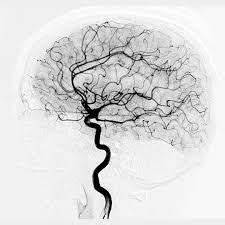 Cerebral Angiogram at Dr. Rao’s Hospital – Brain Imaging
