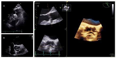 Aortic Stenosis Echo