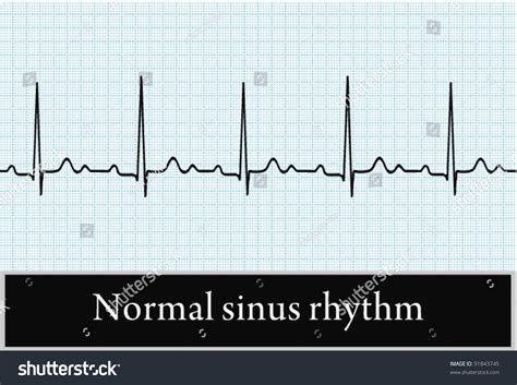 Sinus Rhythm On Ecg Vector Professional Stock Vector (Royalty Free ...