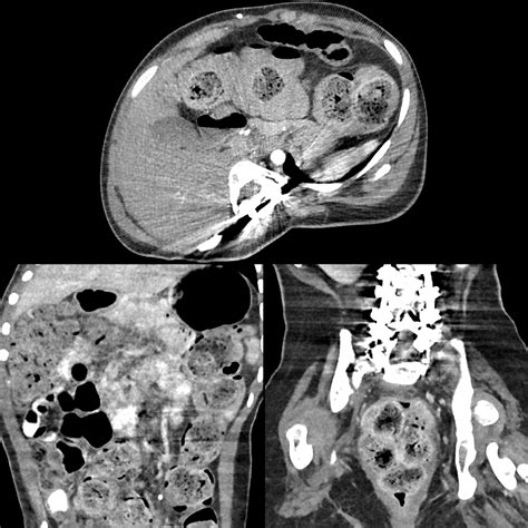 Constipation05MDFeverAndConstipationStercoralColitisWallThickeningAndEn ...