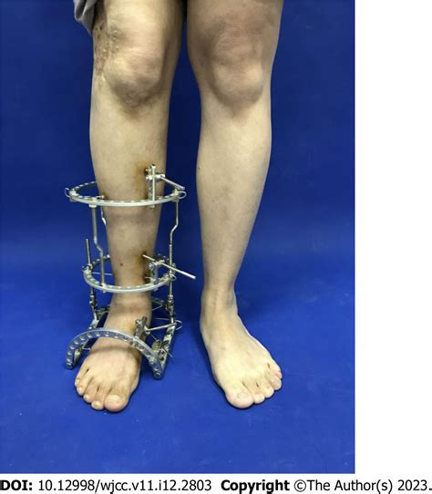 Treatment of talipes equinovarus after triceps surae intramuscular hemangioma surgery by ...