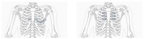 Brugada Syndrome: Focus for the General Pediatrician