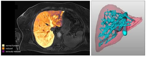 MELIF, a Fully Automated Liver Function Score Calculated from Gd-EOB ...