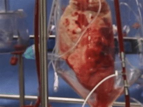 Pig lungs implanted in human, offer new life; Study suggests bees are ...