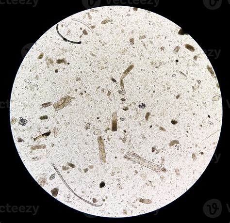 Microscopic urine examination showing Granular cast, a sign of many ...