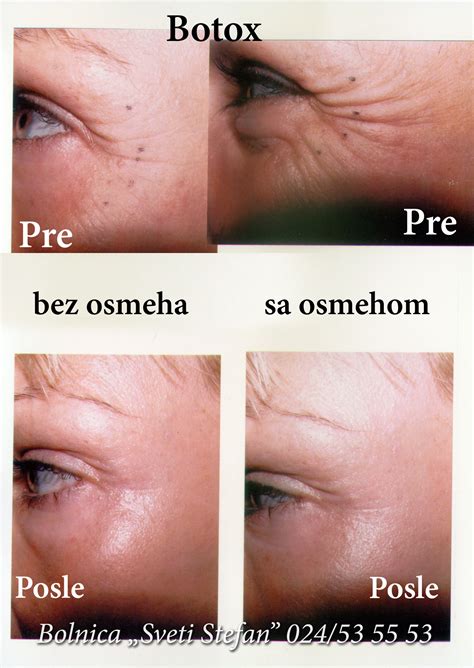 Neoperativna korekcija bora | Bolnica "Sveti Stefan" - Subotica