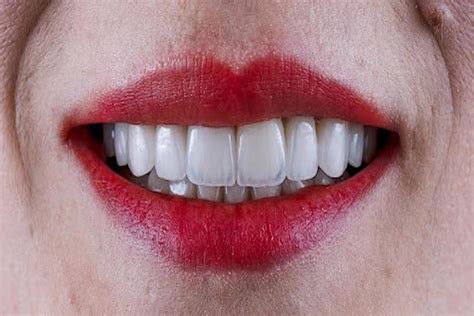 Step-by-Step Guide to Installing Cosmetic Veneers