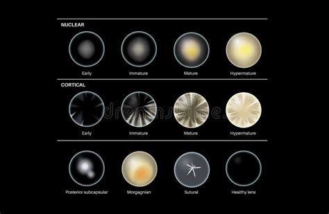 Image result for Types of Vision Problems