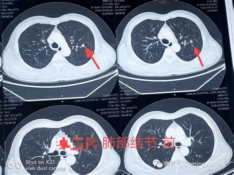 名老中医何明教授 肺部结节治疗前后 病例分享_建议
