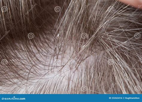 Lice stock photo. Image of lice, nits, eggs, forehead - 23263416