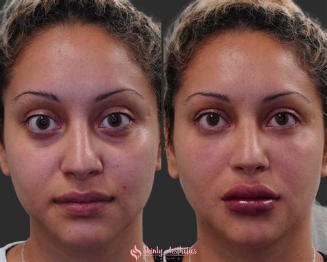 Under Eye Fillers - Before & After Results at Skinly