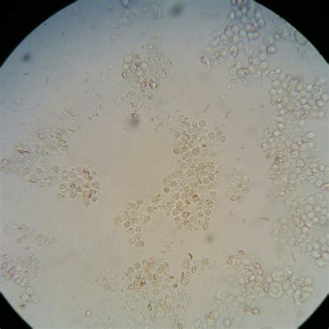 White Particles In Urine Diabetes at Sienna Kraegen blog