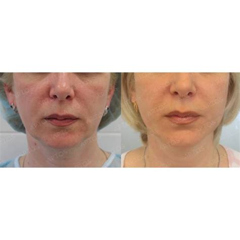 Thread Lift Treatment Cost in Bangalore | Best Doctor for Thread Lift ...