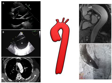 Thoracic Aortic Aneurysm Echocardiogram
