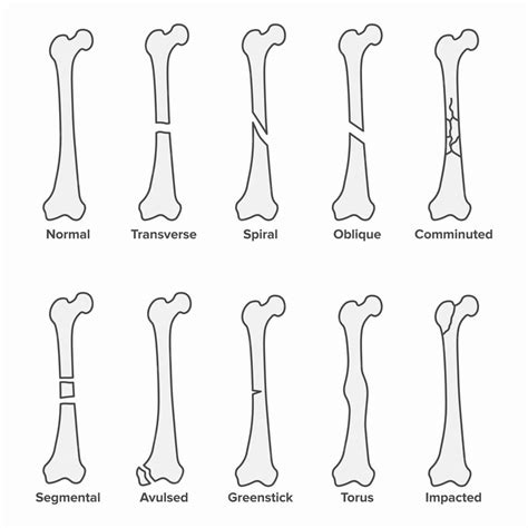 Types De Fractures, Os Brisés | Vecteur Premium