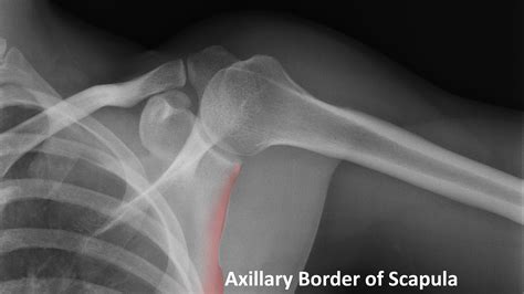 X Ray Normal Shoulder