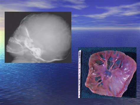 Infant Skull Radiographs | PPT