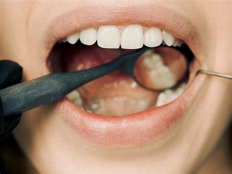 Oral ulcers | Meer