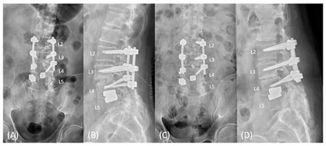 Complete Intradural Interbody Cage Migration in Lumbar Spine Surgery: A Case Report and ...