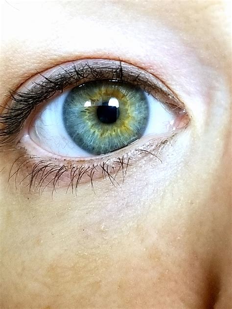 Central Heterochromia Blue Yellow