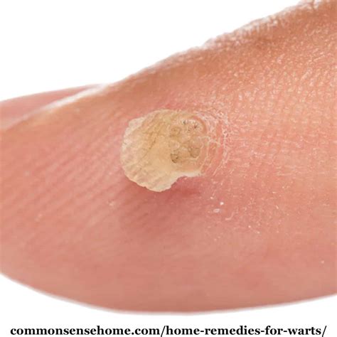 Stages Of Plantar Wart Removal Pictures - Common Wart Removal Tips ...
