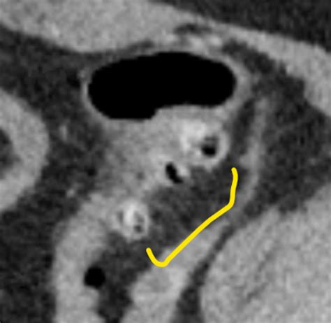 Image result for Colonic Diverticulum CT